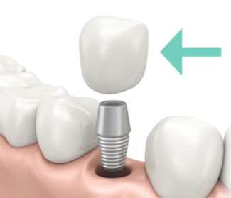 Dental Crowns