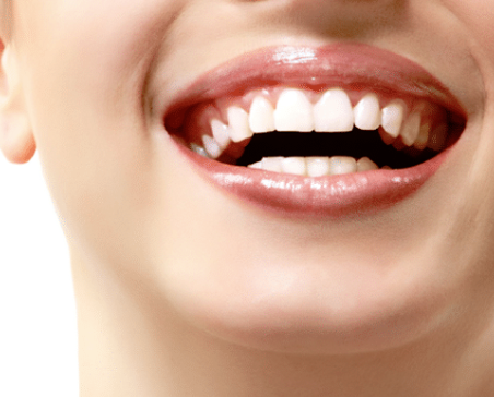 Laser Teeth Whitening