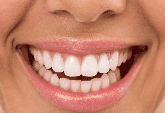 Porcelain Veneers