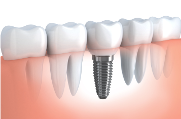 Dental Implants