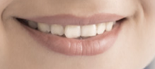 What is Zoom teeth whitening?