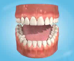 Ceramic Crowns