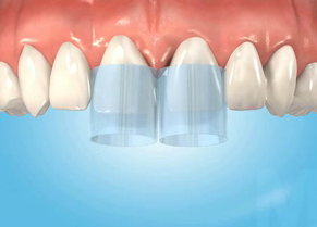 Porcelain Veneers