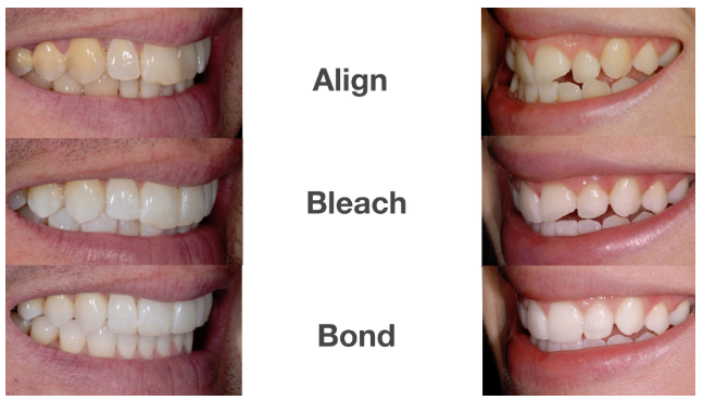 Align, Bleach & Bond