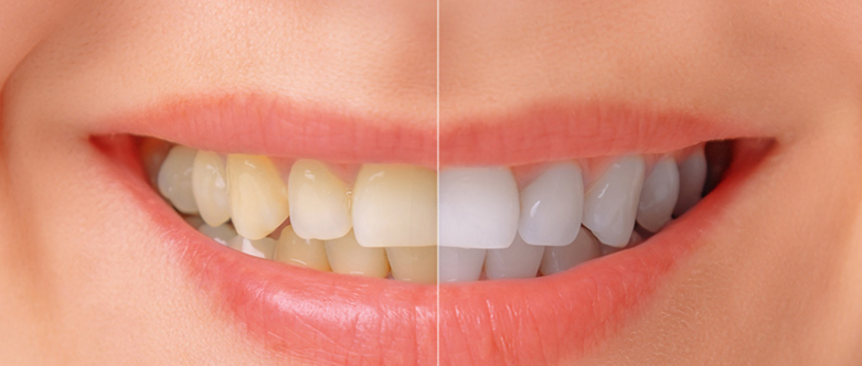 Teeth Whitening