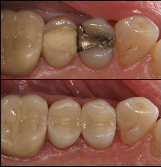 Composite Fillings