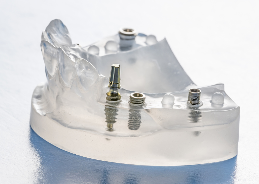 Dental Implants