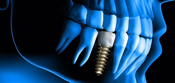 Dental Implants in Essex