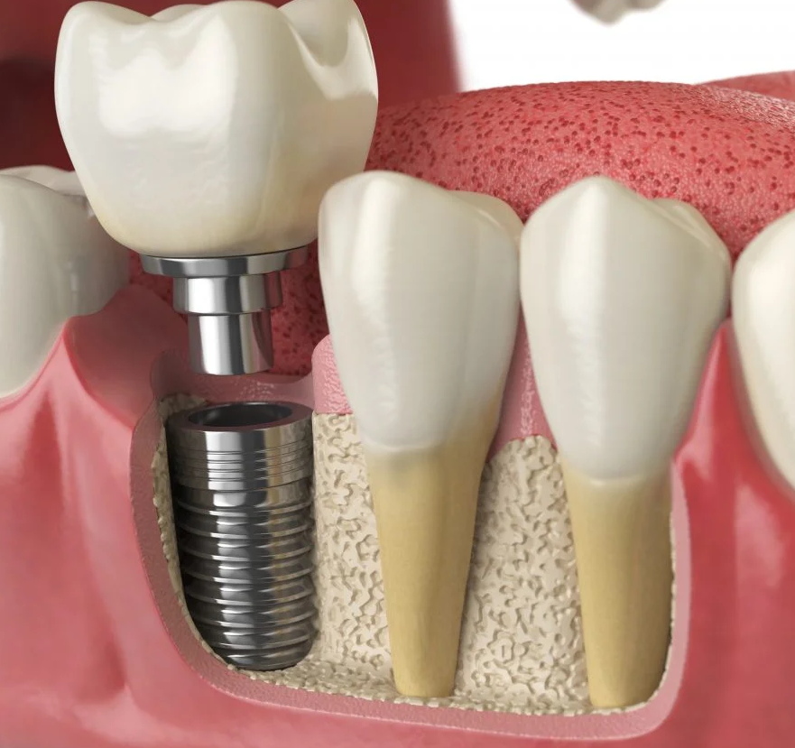 Dental Implants