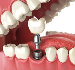 Dental Implants