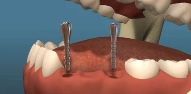 Dental Implants