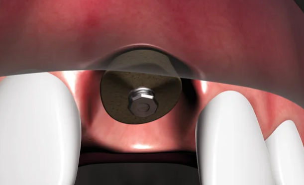 Single Tooth Implants