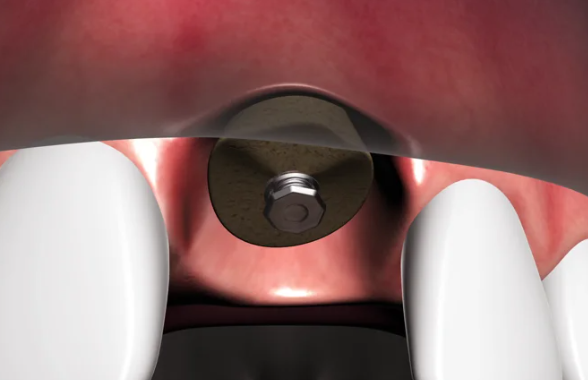 Dental Implants